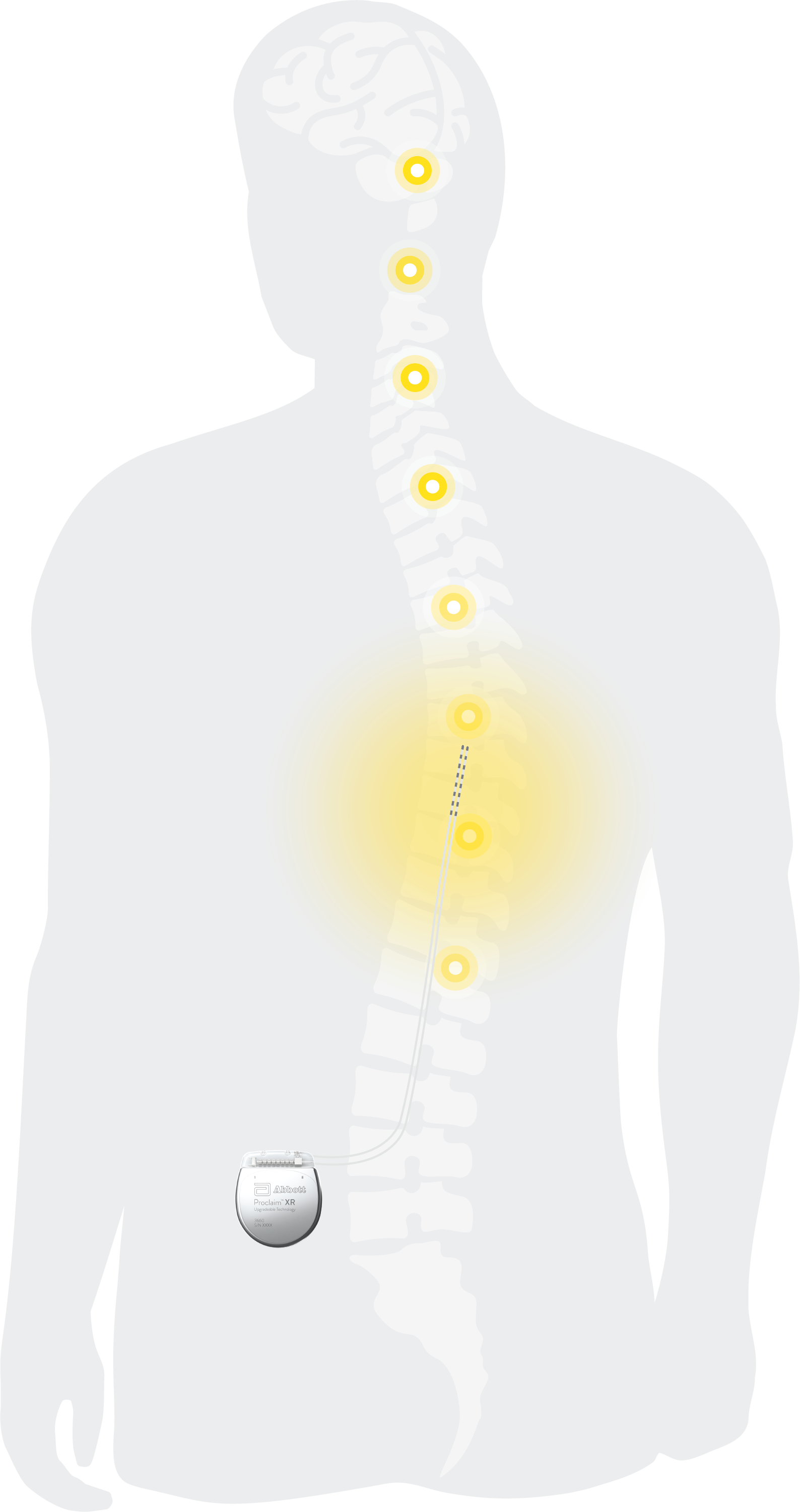 implantation abbott spinal cord stimulator